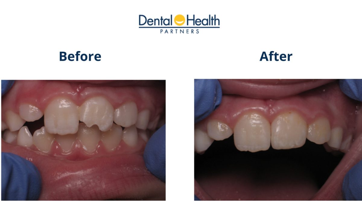 Composite Bonding Before And After Tooth Restoration Dental Health Partners